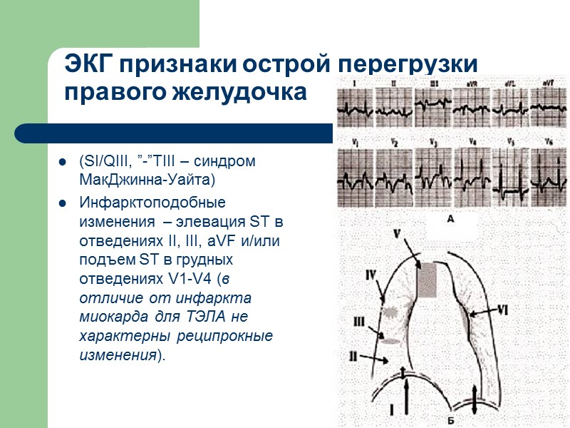 ЭКГ признаки острой перегрузки правого желудочка (SI/QIII, ”-”TIII – синдром МакДжинна-Уайта) Инфарктоподобные изменения –